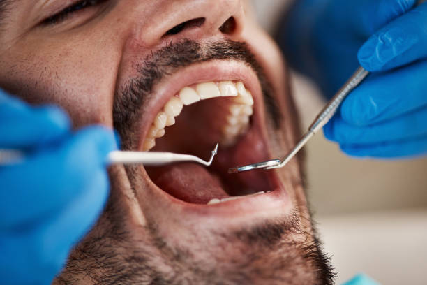 Best Knocked-Out Tooth (Avulsed Tooth) Treatment in Burlington, KY